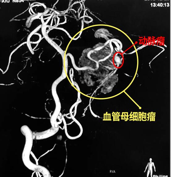 2年反复恶心呕吐 错把脑肿瘤当作胃病治