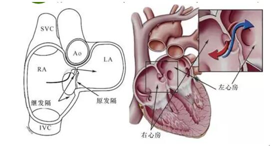 咦 心脏的小孔没有闭合也有引发脑卒中