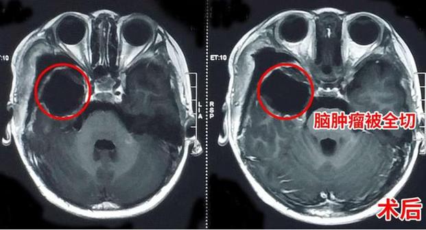 4岁男孩肚子有个“小球球”在跳 没想到是脑肿瘤捣乱