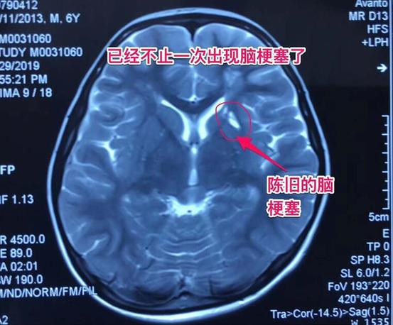 6岁儿童屡发脑梗 原来他的脑内血管中竟“烟雾缭绕”