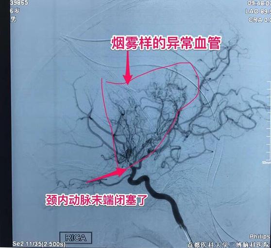 6岁儿童屡发脑梗 原来他的脑内血管中竟“烟雾缭绕”