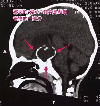 3岁男童身高比同龄矮一头 没想到是脑肿瘤捣乱