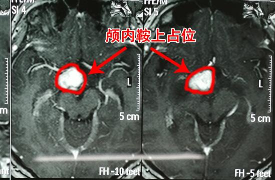 胸部变大的男孩 竟是因为这病作祟