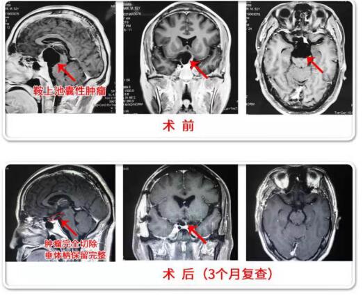 周忠清：在颅咽管瘤领域，没什么比成功的手术更具有说服力