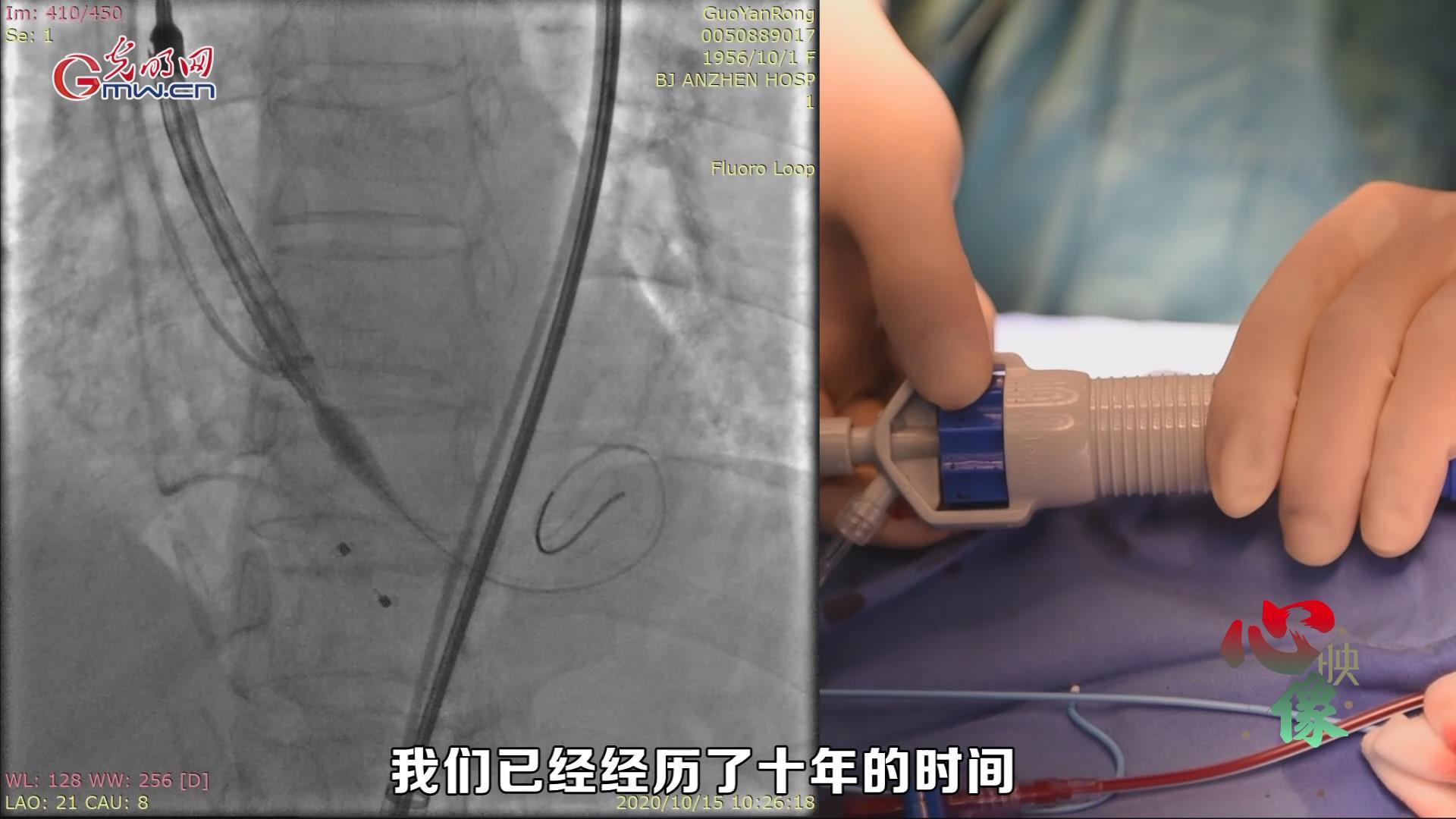 【光明卫生•心映像】刘巍:用不开胸的手术,保护最后一道生门 【光明卫生•心映像】刘巍:用不开胸的手术,保护最后一道生门