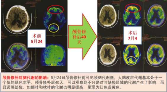 去骨瓣减压后颅骨修补的时机、材料应用和并发症