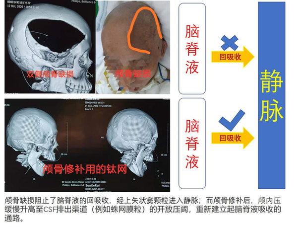 去骨瓣减压后颅骨修补的时机、材料应用和并发症