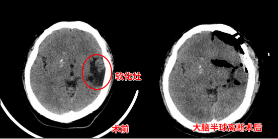 青年一半大脑被离断 困扰20年癫痫终结了