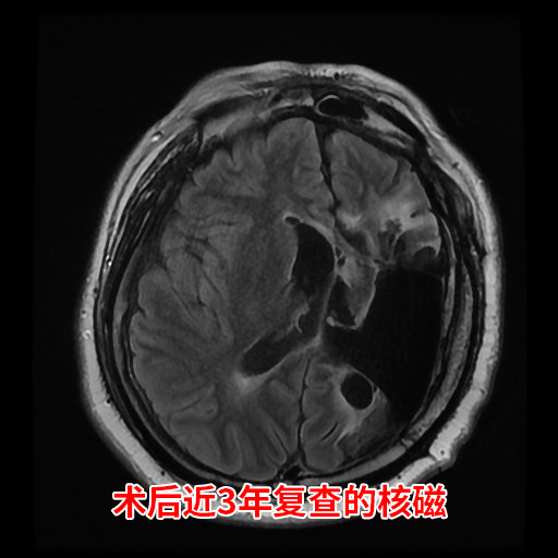 青年一半大脑被离断 困扰20年癫痫终结了