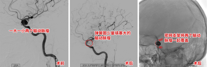 头痛欲裂揪出“蚕豆”大脑动脉瘤 新式介入栓塞术巧“拆弹”