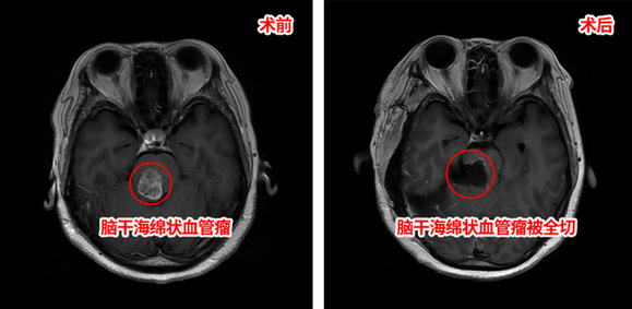 海绵状血管瘤深入脑干 三博专家为生命中枢“排雷”