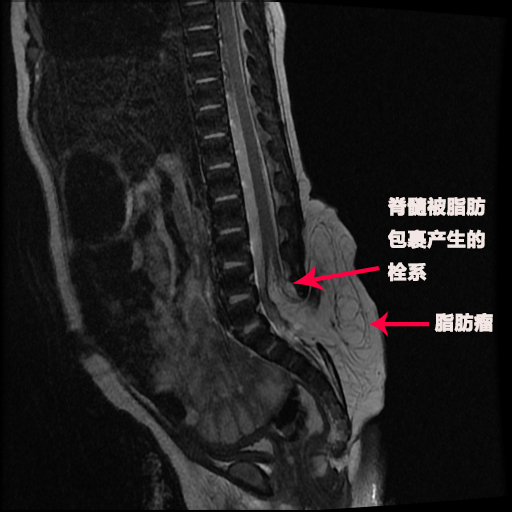 刚出生的宝宝屁股后有鹅蛋大的鼓包 医生妙手修补脊柱裂