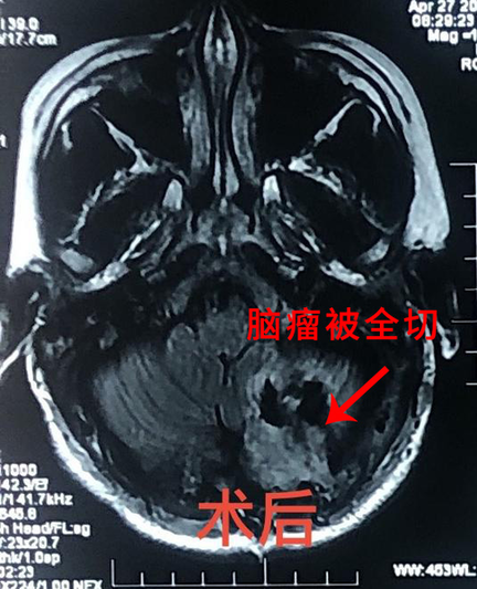 12岁男孩脑瘤3个月疯长3倍 神外专家妙手成功“拆弹”