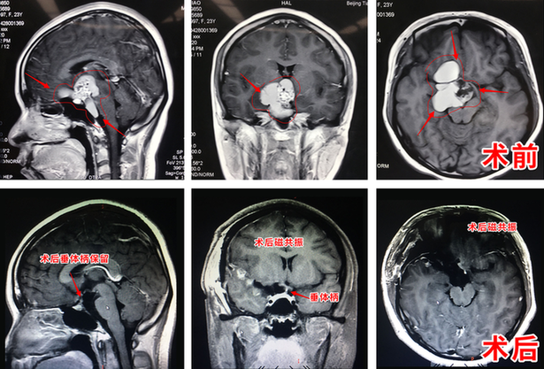罕见颅咽管瘤包绕脑血管压迫视神经 医生抽丝剥茧摘瘤