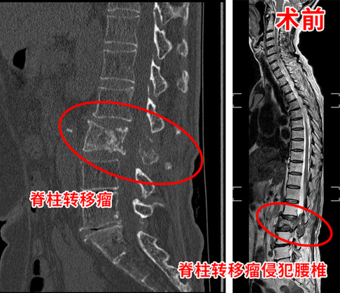 腰椎椎体被肿瘤吃“光” 一个切口切除整块腰椎肿瘤一并把椎体重建好