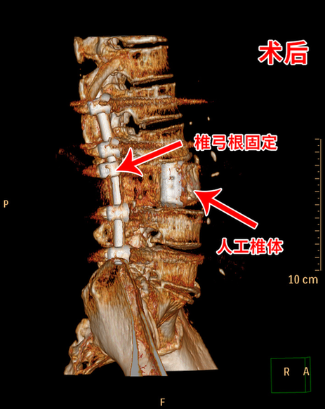 腰椎椎体被肿瘤吃“光” 一个切口切除整块腰椎肿瘤一并把椎体重建好