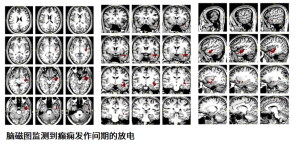 年轻小伙不分场合莫名“痴笑” 专家精准置入电极根除病灶