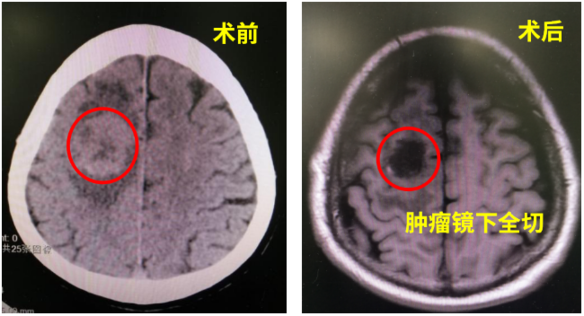 拯救83岁患脑癌的老父亲