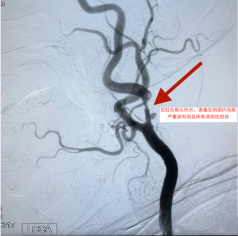 颈内动脉支架术中栓子脱落太多险象环生 专家巧妙化解
