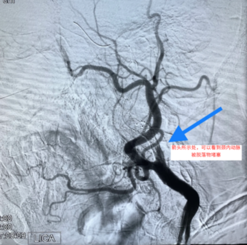 颈内动脉支架术中栓子脱落太多险象环生 专家巧妙化解