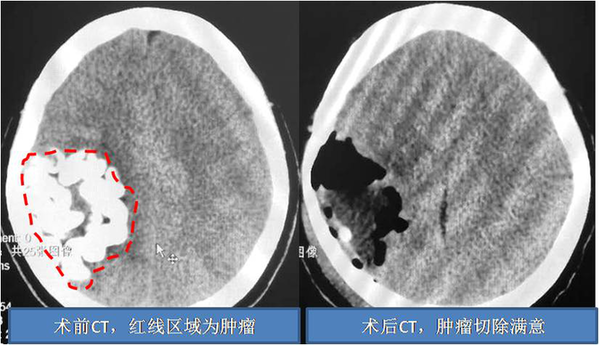 肢体麻木竟是脑肿瘤作祟！专家妙手将近5公分大小肿瘤全切