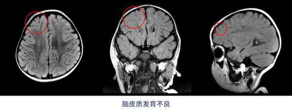 2岁宝宝一天癫痫发作20多次 根在脑皮质发育不良