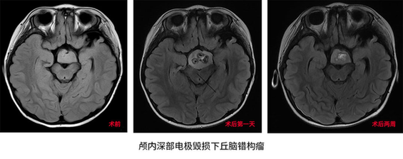 3岁女童爱笑性格好？原来是脑内错构瘤！不开颅置入电极根除病灶治癫痫