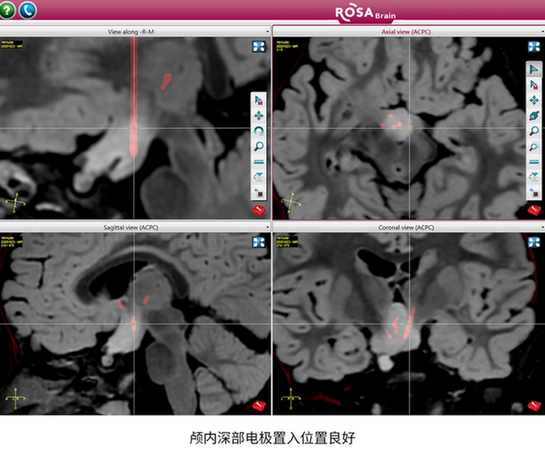 3岁女童爱笑性格好？原来是脑内错构瘤！不开颅置入电极根除病灶治癫痫