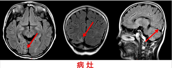 10岁男童癫痫4年 精准手术切癫痫灶“除根”