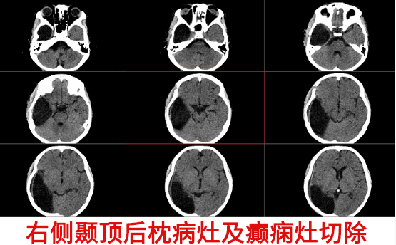 10岁男童癫痫4年 精准手术切癫痫灶“除根”