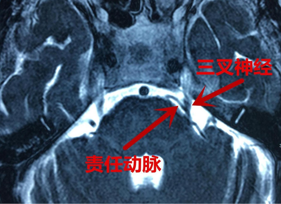 脸像电击一样痛？微血管减压术为三叉神经痛女子“一垫除痛”