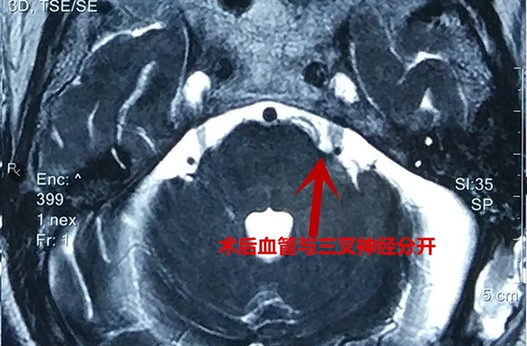 脸像电击一样痛？微血管减压术为三叉神经痛女子“一垫除痛”
