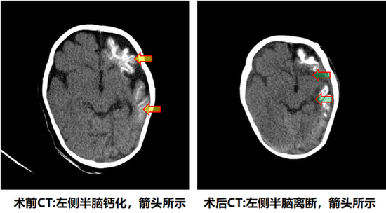 面部红斑宝宝一天癫痫发作60余次 半球离断术为其除病魔
