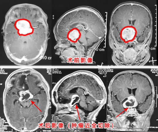 5月大宝宝眼球异常转动 竟是患了这种可怕脑肿瘤