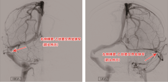 莫名头痛伴视力模糊病因竟是静脉窦狭窄 支架置入“天堑变通途”