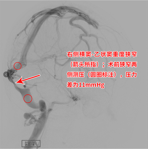 莫名头痛伴视力模糊病因竟是静脉窦狭窄 支架置入“天堑变通途”