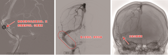 莫名头痛伴视力模糊病因竟是静脉窦狭窄 支架置入“天堑变通途”