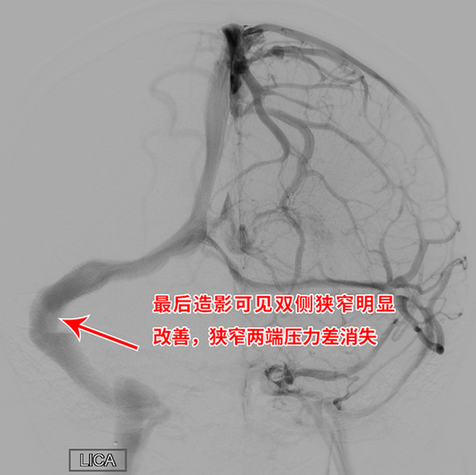 莫名头痛伴视力模糊病因竟是静脉窦狭窄 支架置入“天堑变通途”